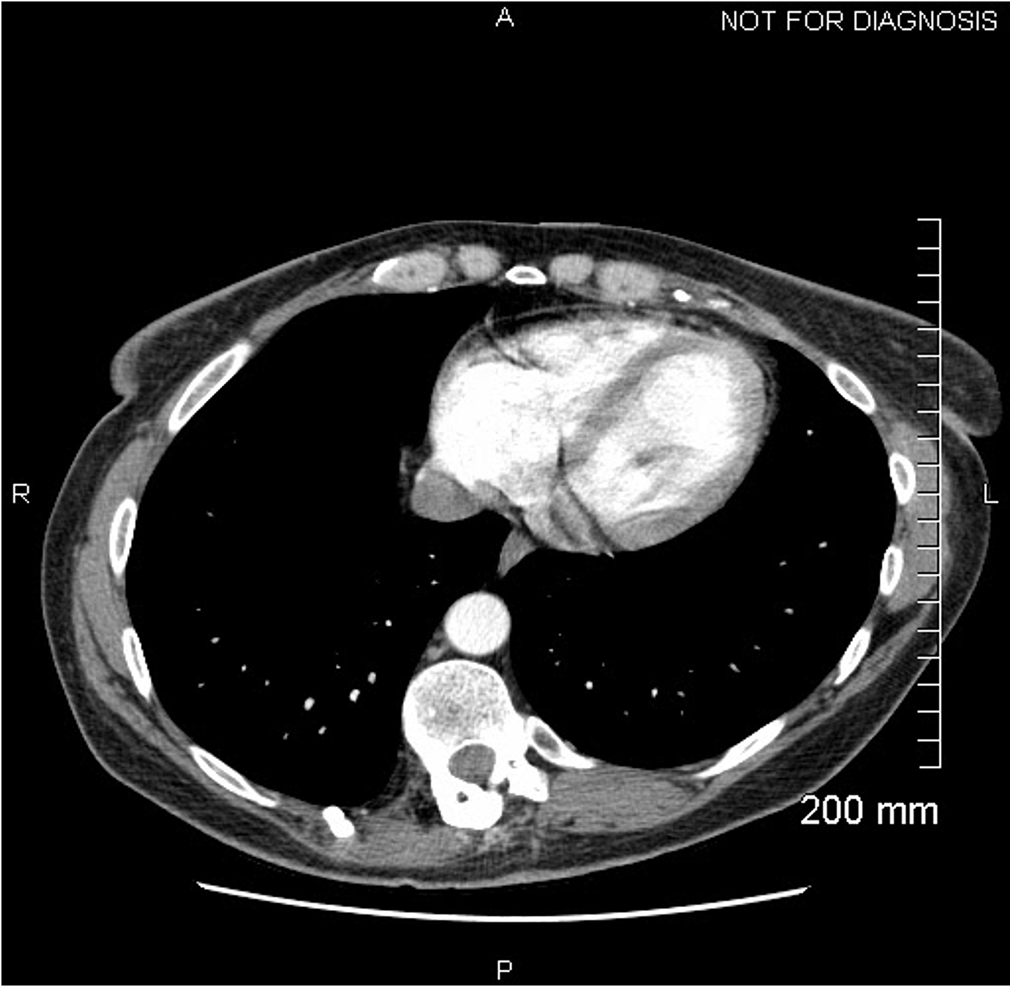 Cureus | An Unusual Presentation of COVID-19: Hemorrhagic Pericardial ...