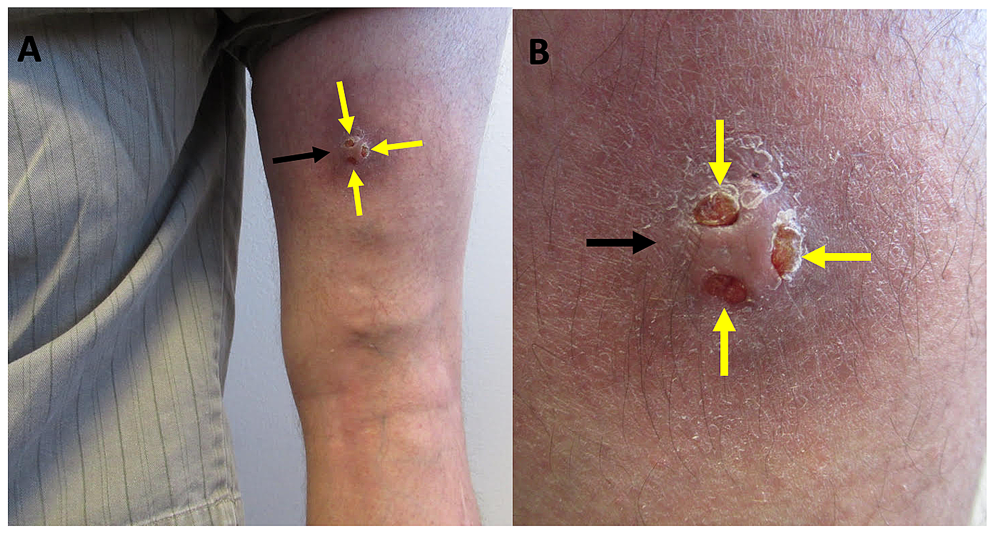 Cureus Ectopic Hidradenitis Suppurativa Case Report And Review Of Literature