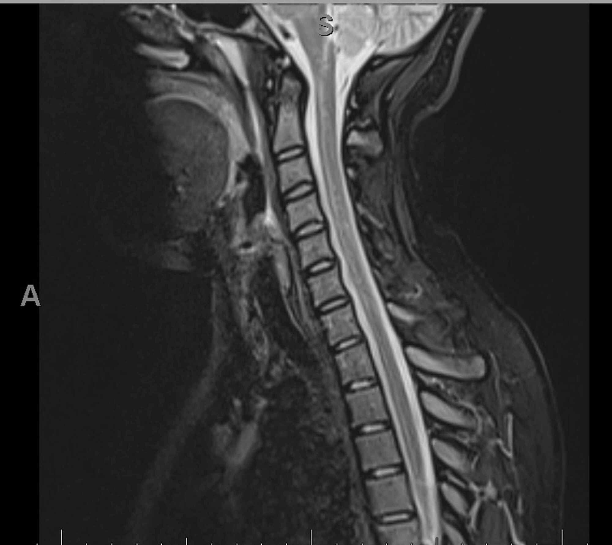 Cureus Guillain Barre Syndrome Associated With Covid 19 Infection A Case Report With Review Of Literature