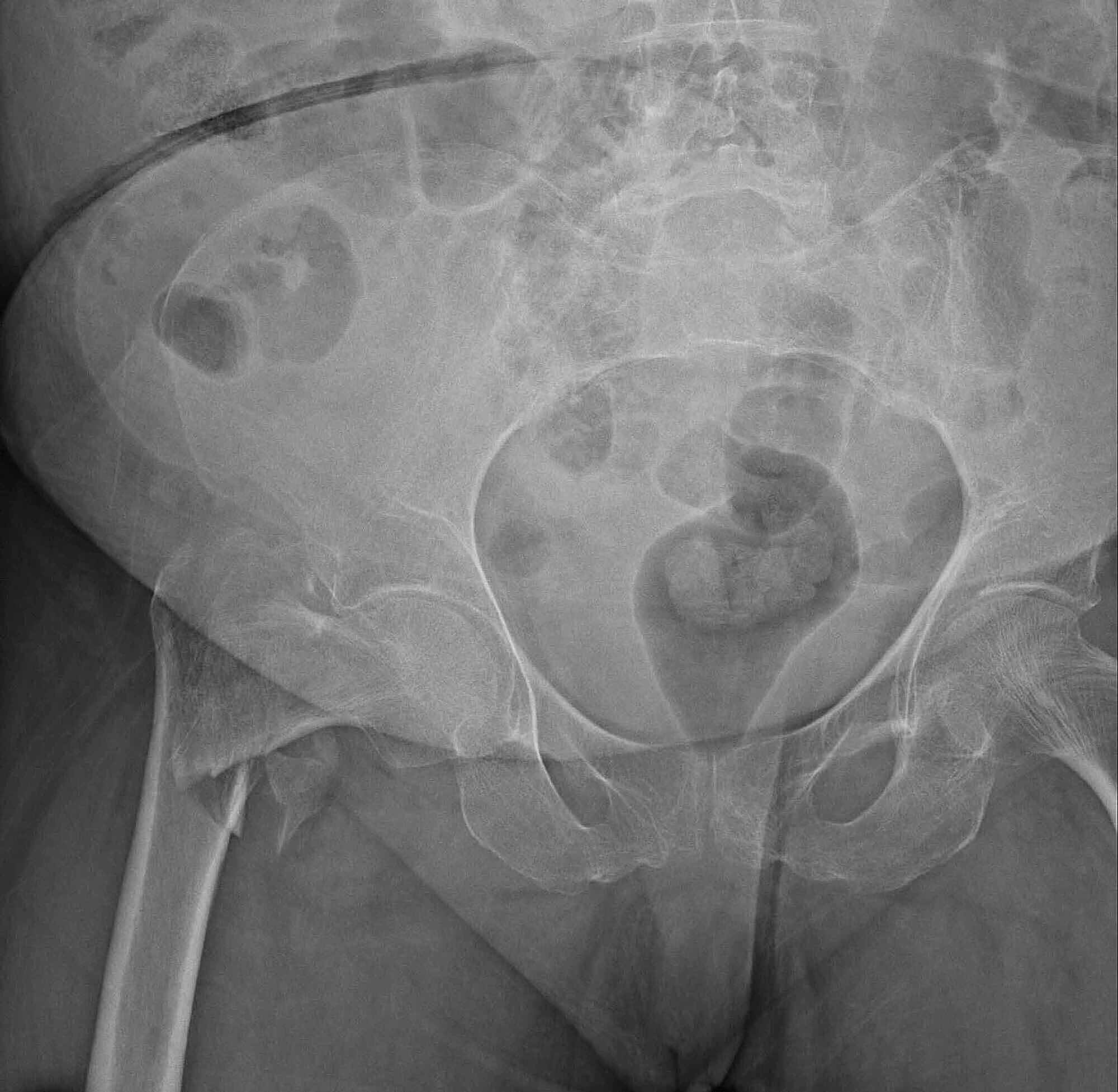 Cureus Comparison Of Cementless Calcar Replacement Hemiarthroplasty With Proximal Femoral Nail For The Treatment Of Unstable Intertrochanteric Fractures At Older Age Group