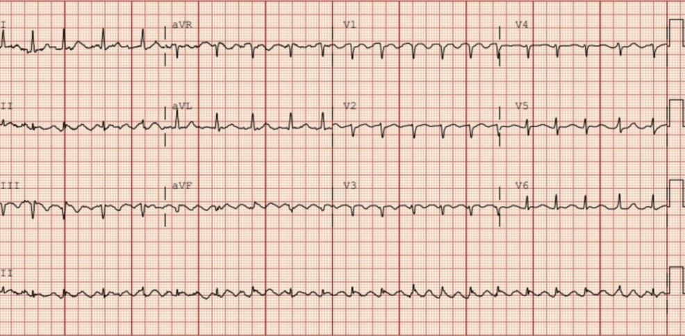 tirzepatide and tachycardia New-Onset Atrial Fibrillation Potentially Associated With Tirzepatide: A  Case Report