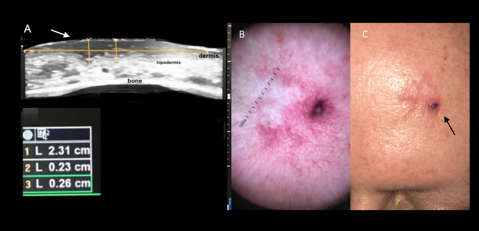 High-Resolution Ultrasound as a Key Tool for Dermatologic Surgery