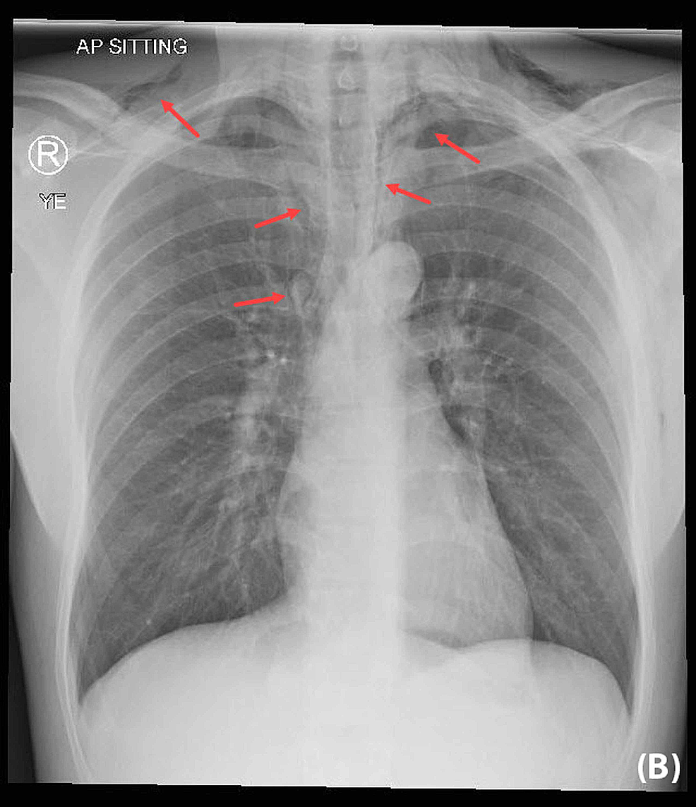 Cureus Spontaneous Subcutaneous Emphysema and Pneumomediastinum