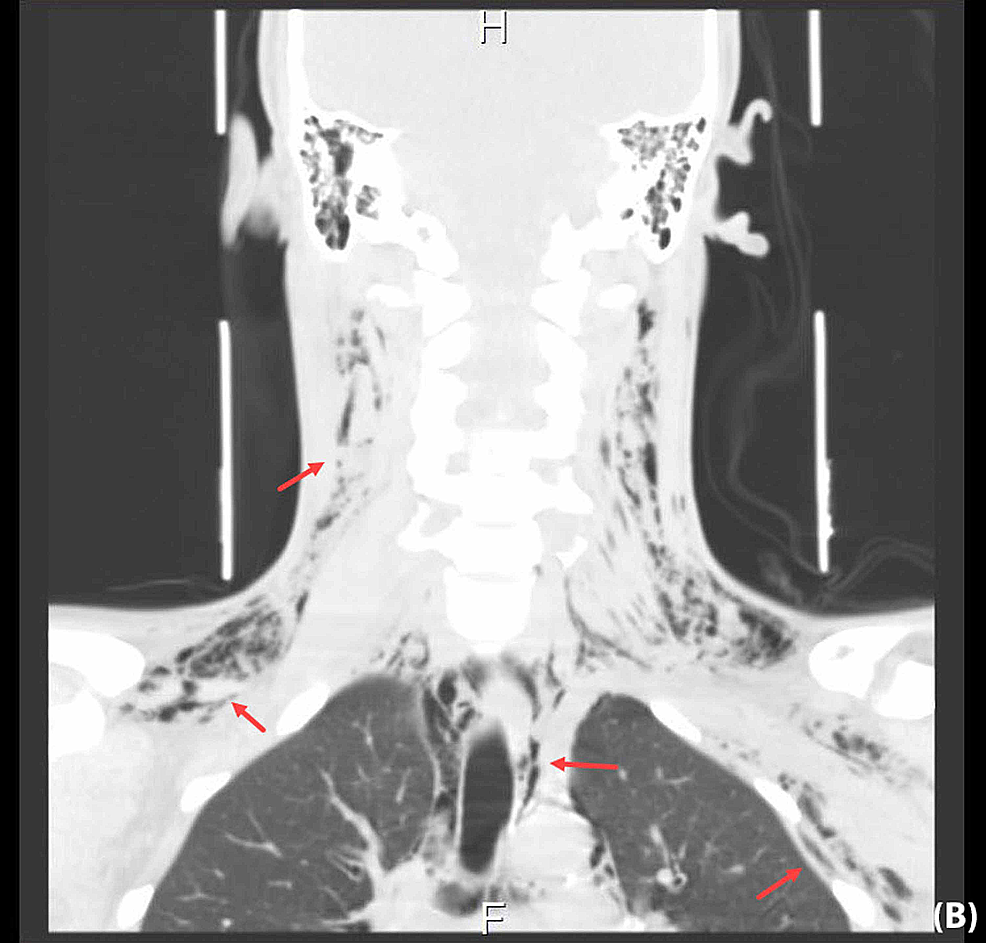 Cureus Spontaneous Subcutaneous Emphysema and Pneumomediastinum
