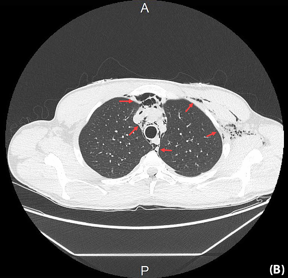 Cureus Spontaneous Subcutaneous Emphysema and Pneumomediastinum