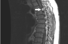 ommaya chemotherapy intrathecal recession leptomeningeal reservoir improves cosmesis undergoing patients disease cureus familial intradural thoracic cavernoma extramedullary multiple man