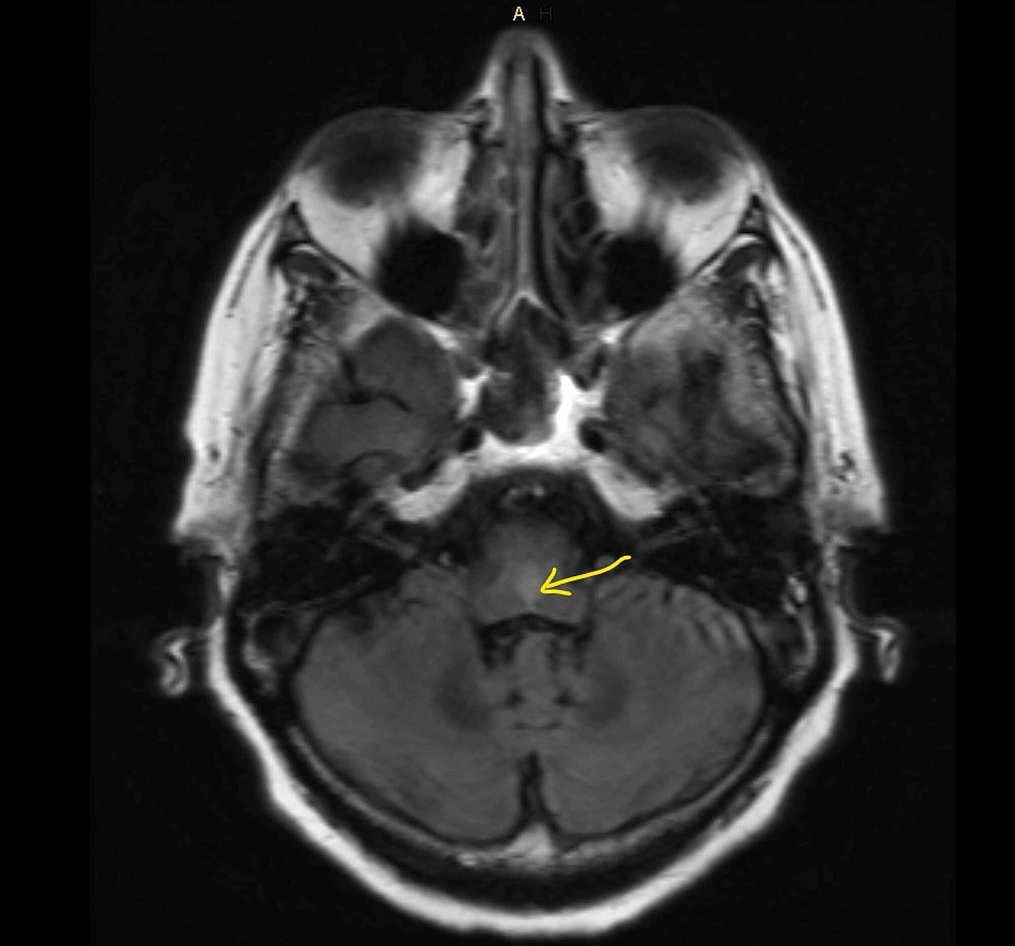 Cureus | Brain Stem Encephalitis in a Patient With Recurrent Small Cell ...