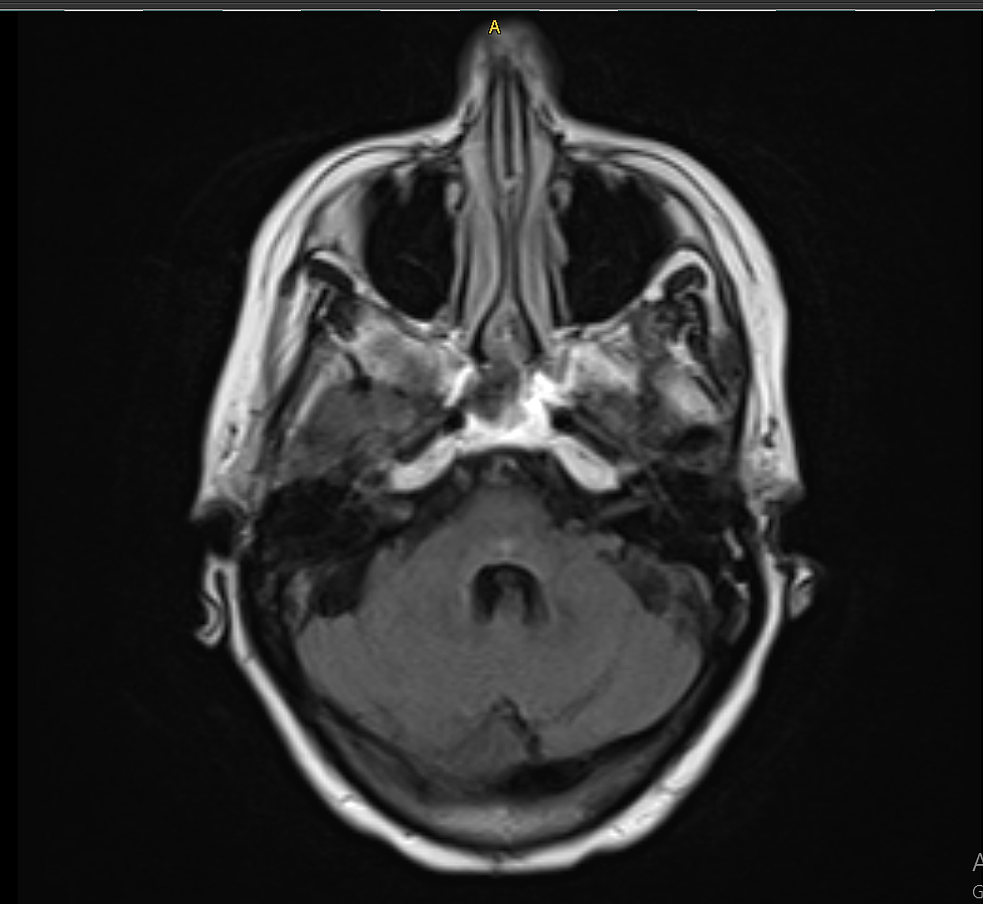 Cureus | Brain Stem Encephalitis in a Patient With Recurrent Small Cell ...