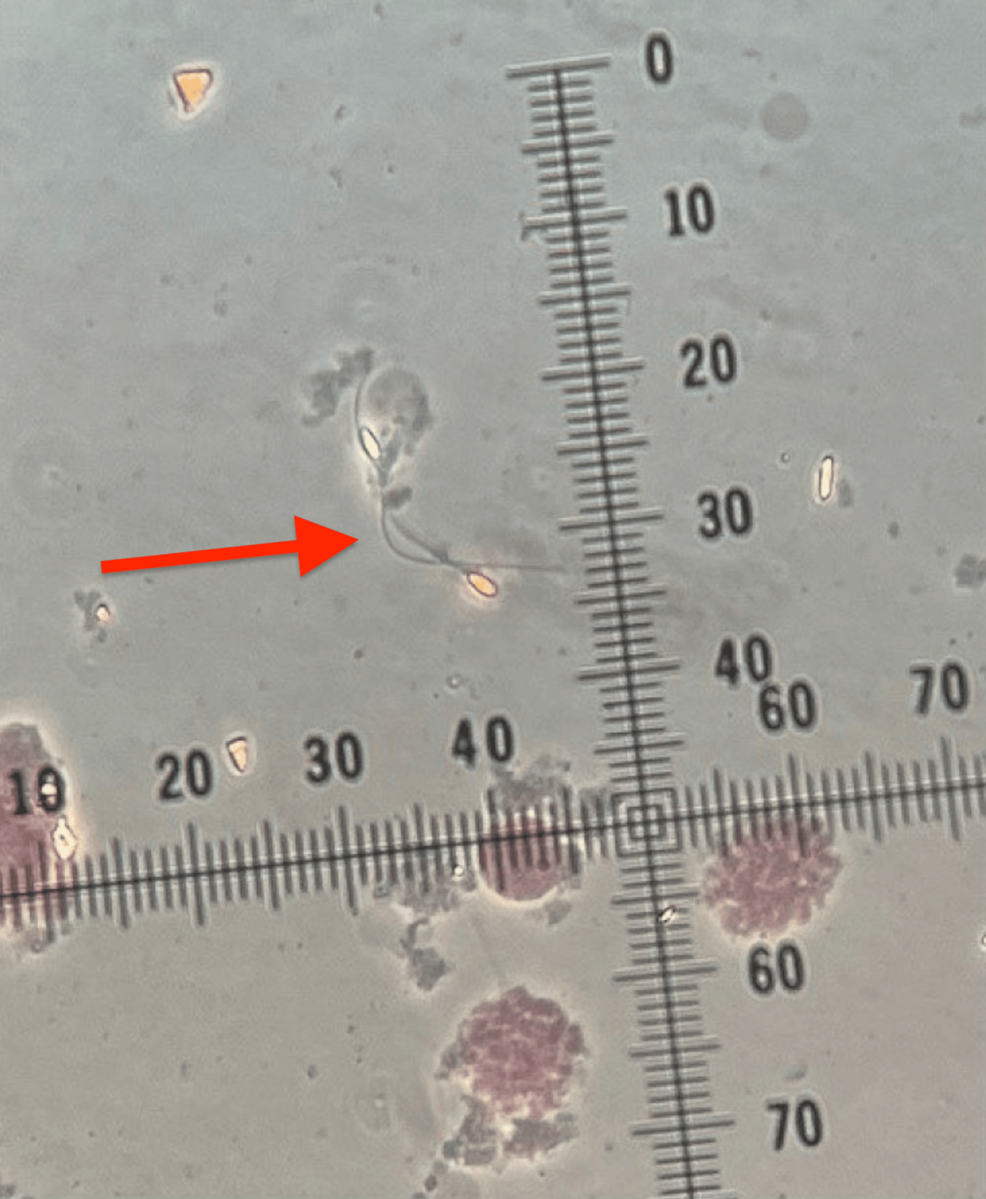 glutathione testosterone reddit Successful Surgical Sperm Extraction in a Patient With Cystinosis Skin Concern_Redness/Soreness