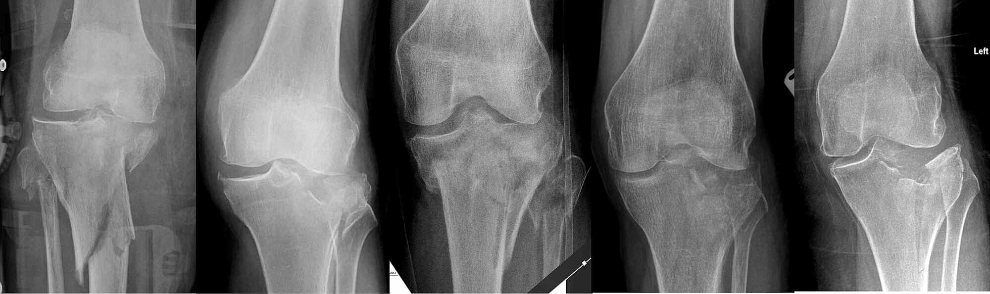 closed fracture tibial plateau