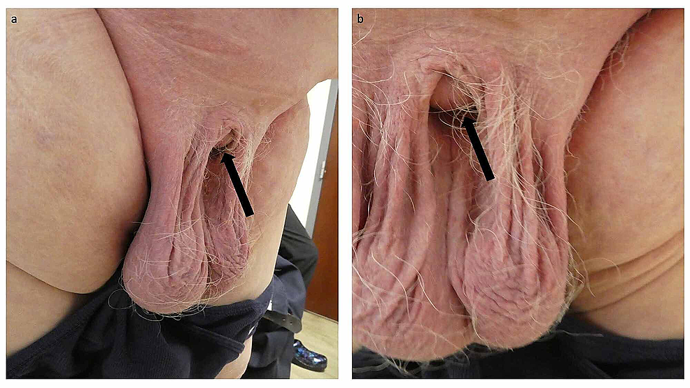 Adult-acquired-buried-penis-in-a-62-year-old-obese-man-with-condition-associated-recurrent-Candida-intertrigo