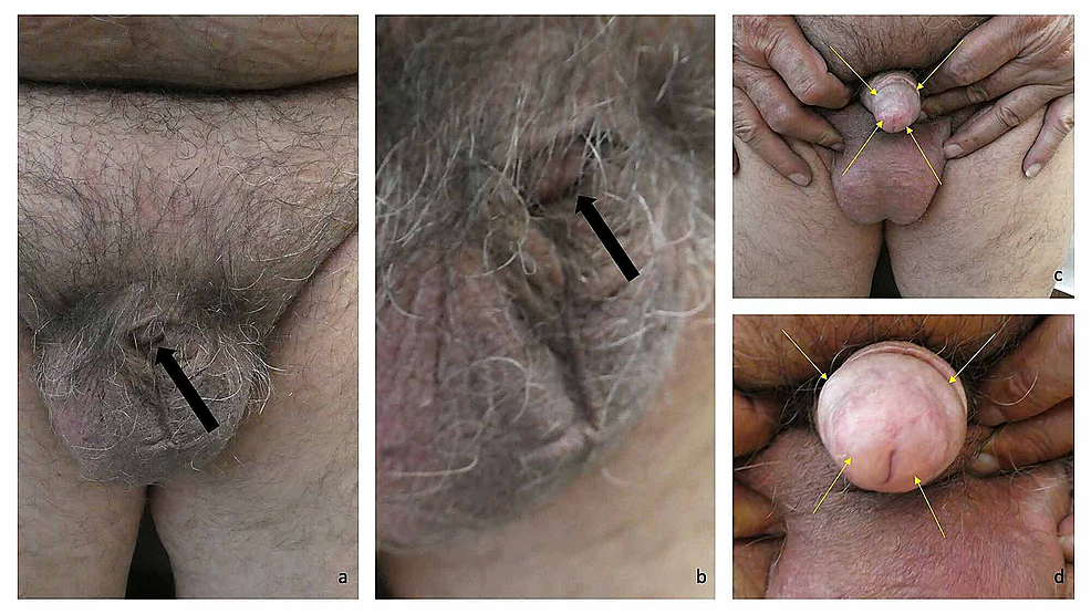 Adult-acquired-buried-penis-in-a-71-year-old-obese-man-with-condition-related-lichen-sclerosus
