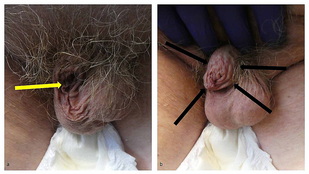Adult-acquired-buried-penis-in-an-87-year-old-obese-man