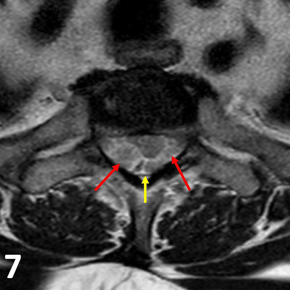 Clinical Presentation Of Extramedullary Versus Intramedullary Spinal