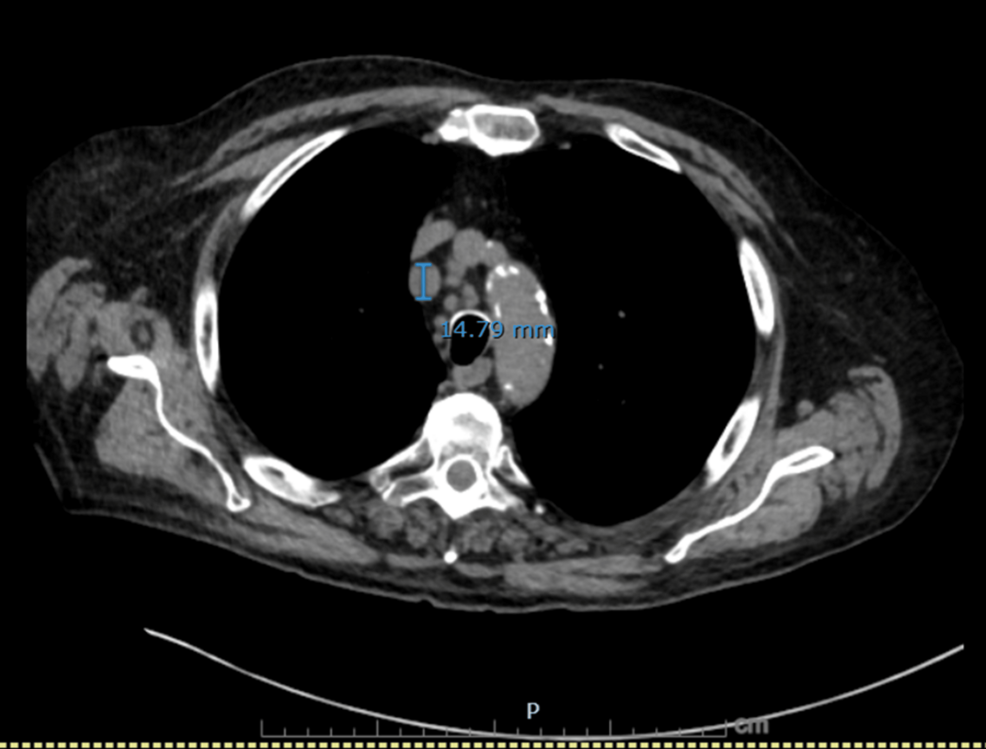 Axial-CT-chest-showing-an-enlarged-right-paratracheal-lymph-node.