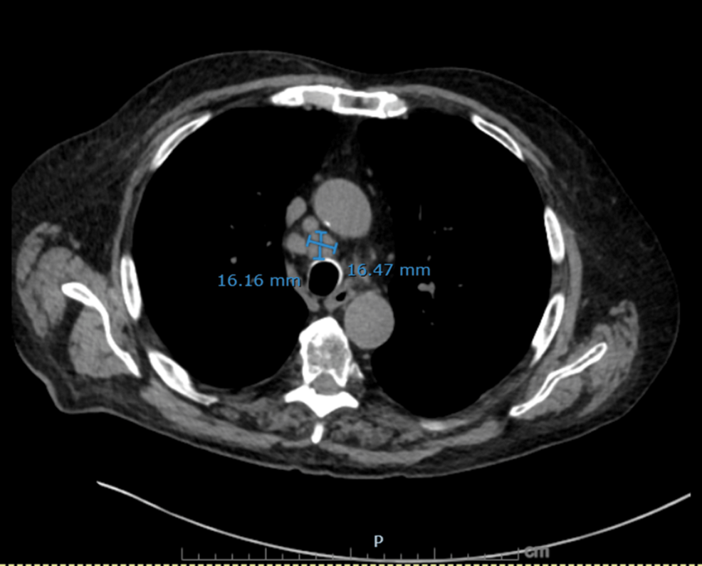 Non-contrast-axial-CT-chest-showing-a-dominant-right-paratracheal-lymph-node