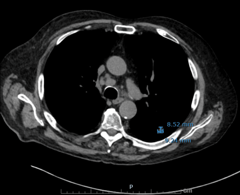 Axial-non-contrast-CT-chest-demonstrating-residual-treated-left-lower-lobe-lesion