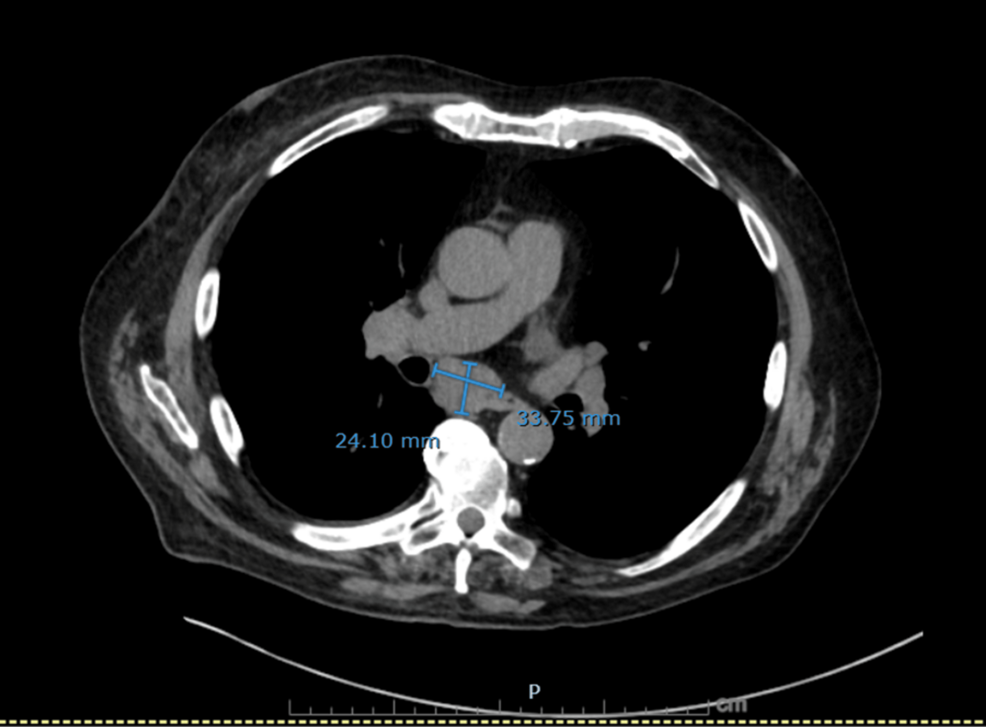 Axial-non-contrast-CT-chest-showing-markedly-enlarged-subcarinal-lymph-node