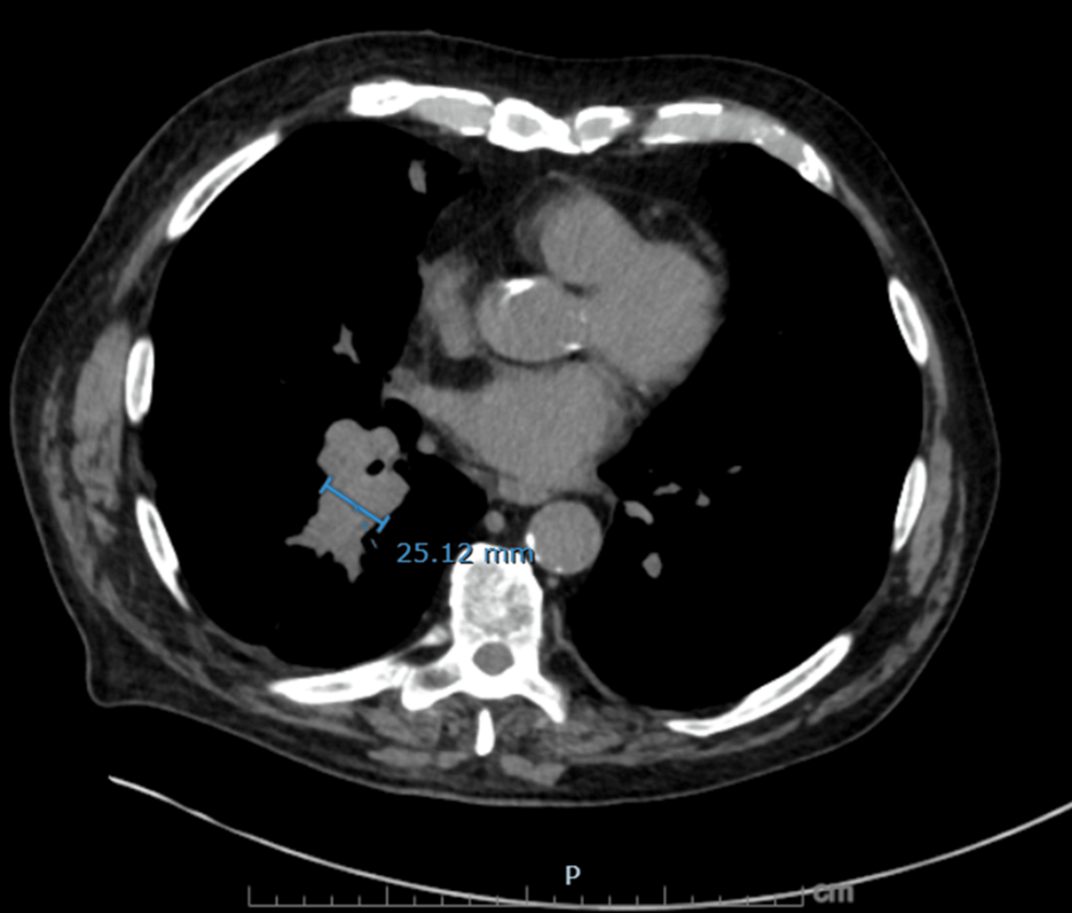 Axial-non-contrast-CT-chest-showing-right-infrahilar-mass-like-fullness