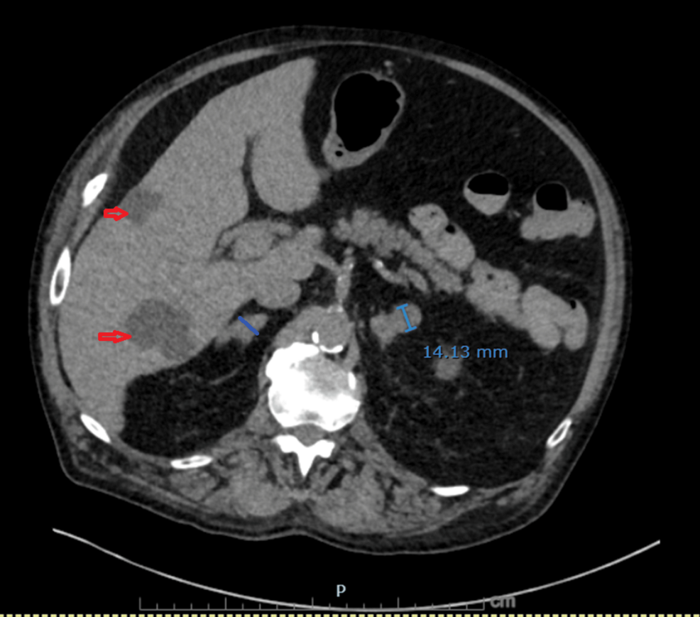 Non-contrast-CT-demonstrating-bilateral-adrenal-metastases