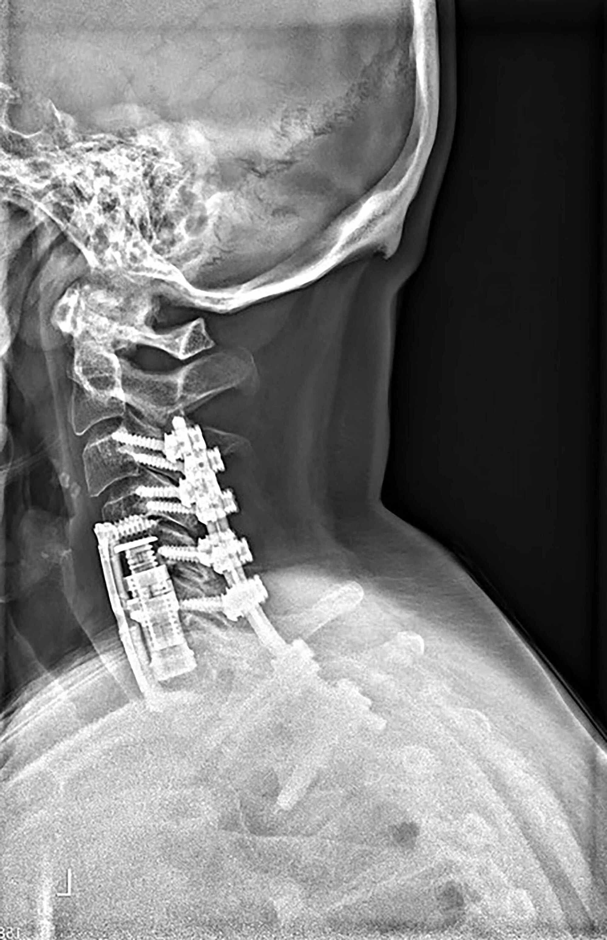 Cureus | Compressive Cervical Myelopathy in Patients With Demyelinating ...