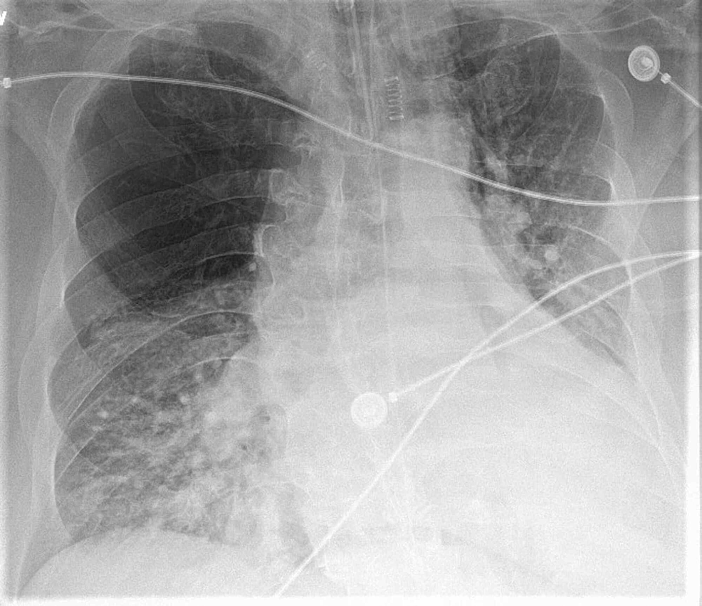 Cureus | A Rare Presentation of a Rare Case: Acute Respiratory Failure ...