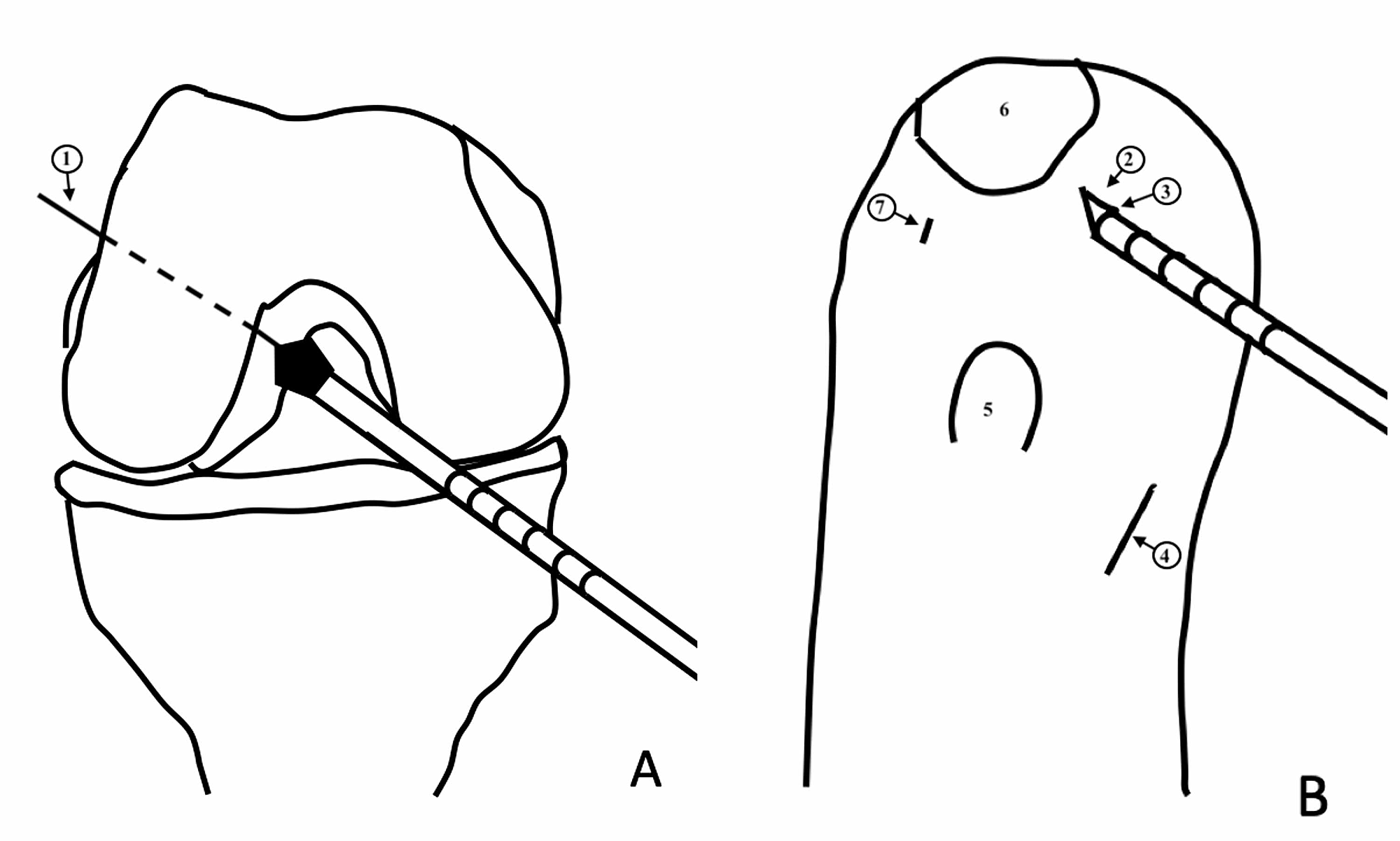 Cureus Anteromedial Portal Reference Technique for Femoral Tunnel