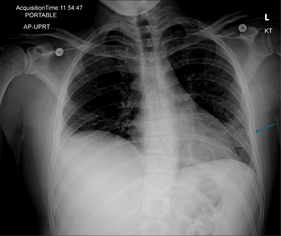 does b12 injection interfere with pfizer covid vaccine Serious Adverse Events Following COVID-19 Vaccination: A Descriptive Case Series From a Rural Healthcare System VITAMIN B12 INJECTION B.P collagen Peptides Size:100 mcg/ml - 1 box (10amp. x 1ml)