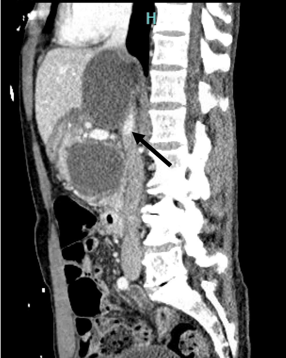Severe Vascular and Ductal Complications of a Pancreatic
