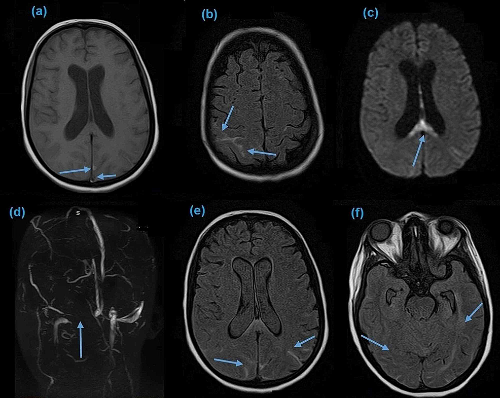 Subarachnoid hemorrhage  Radiology Reference Article