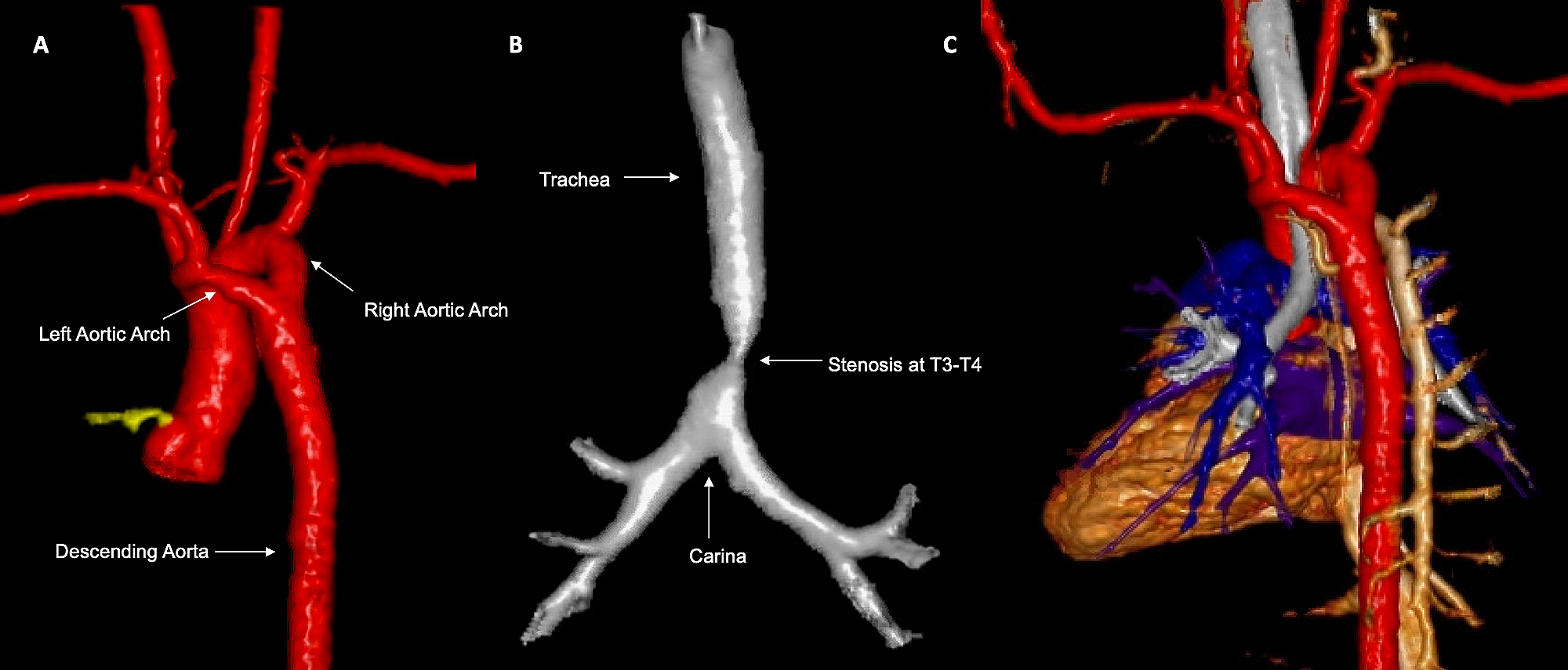 Cureus Noisy Breathing in an Infant A Case Report