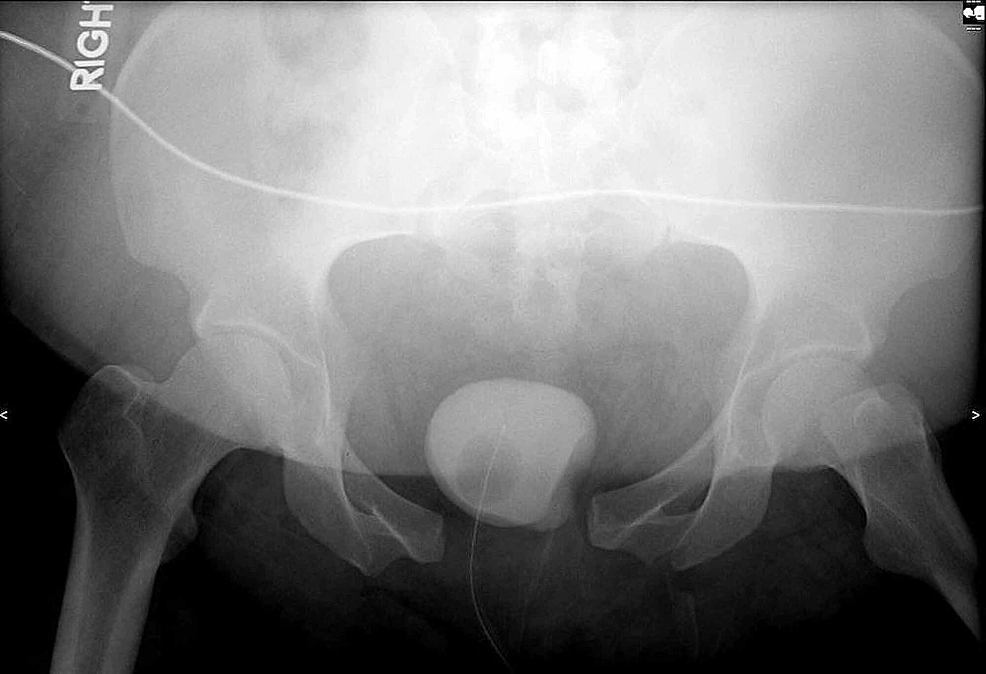 Major disruption of the pelvic ring during normal vaginal delivery: A case  report