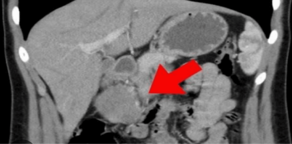 Frantz Tumor: Case Report of Mimicking Pancreatic Pseudocyst - News Directory 3