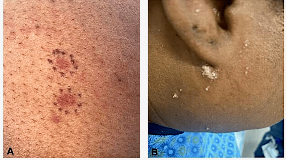 semaglutide side effects rash Semaglutide-Induced Atypical Pustular Drug Eruption: A Case Report