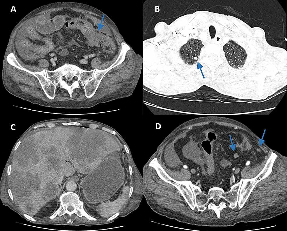 Cureus Unusual Cutaneous Metastases From Colon Adenocarcinoma 