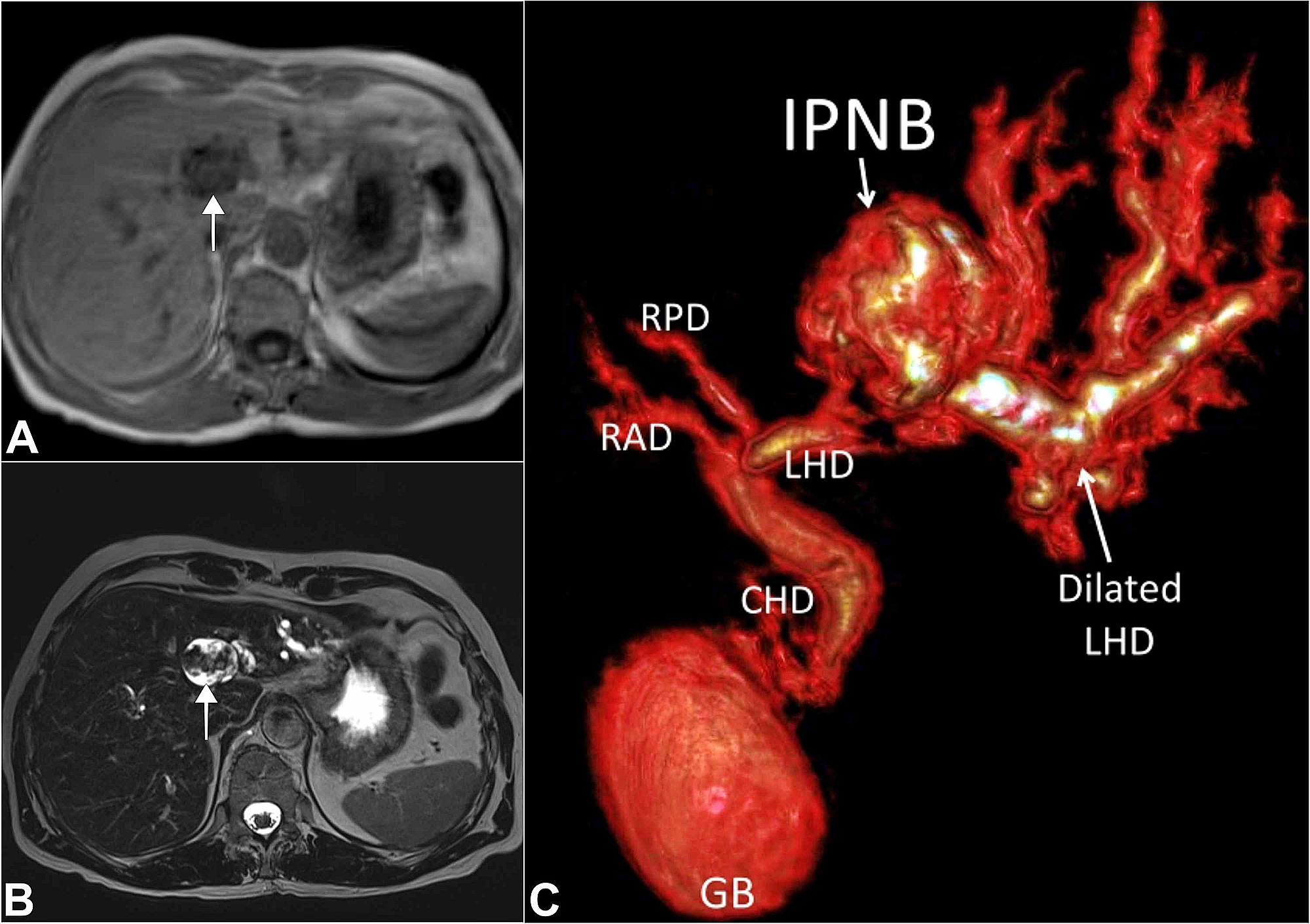 Cureus Intraductal Papillary Neoplasm Of The Bile Duct A Rare Case Of Intrahepatic Space