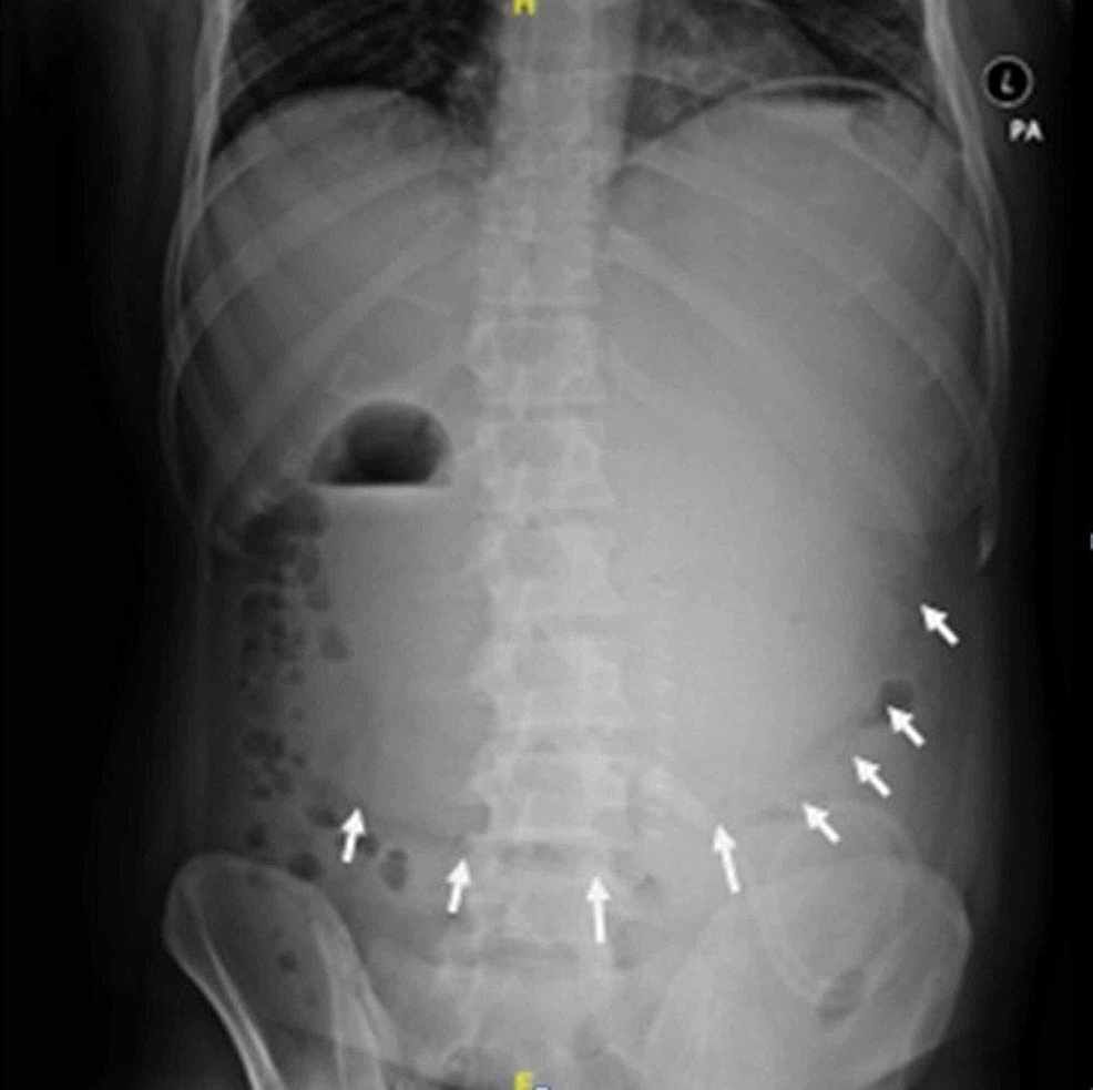 Cureus Acute Massive Gastric Dilatation And Gastric Perforation As A Result Of Closed Loop
