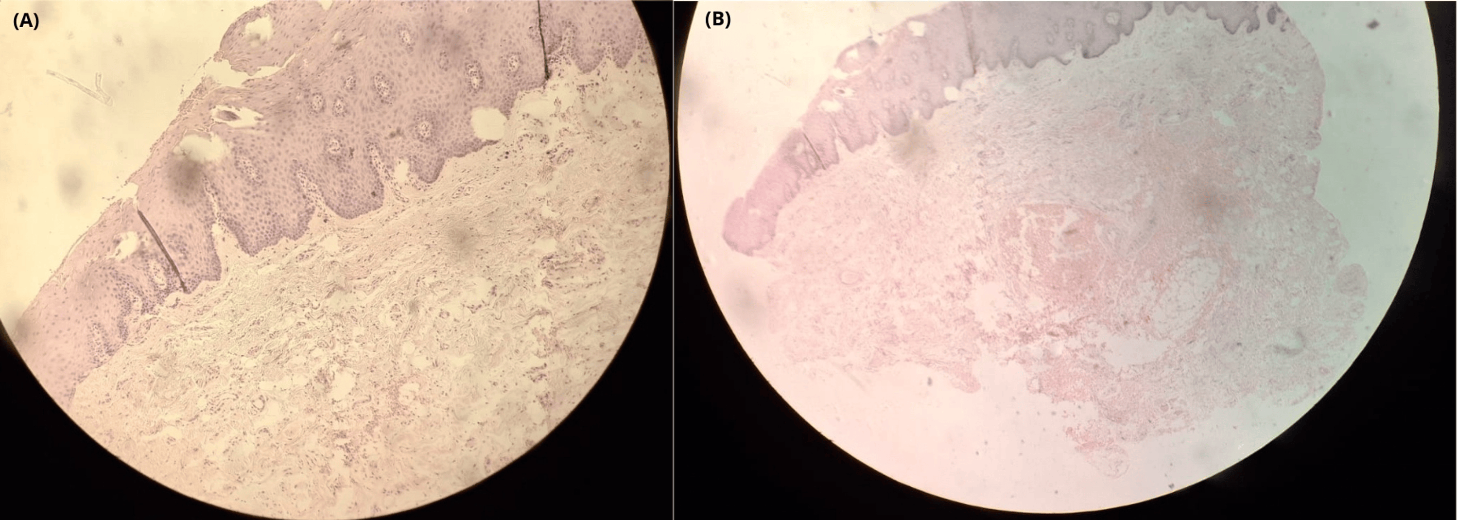congenital lingual melanotic macule oral melanotic macule - Search