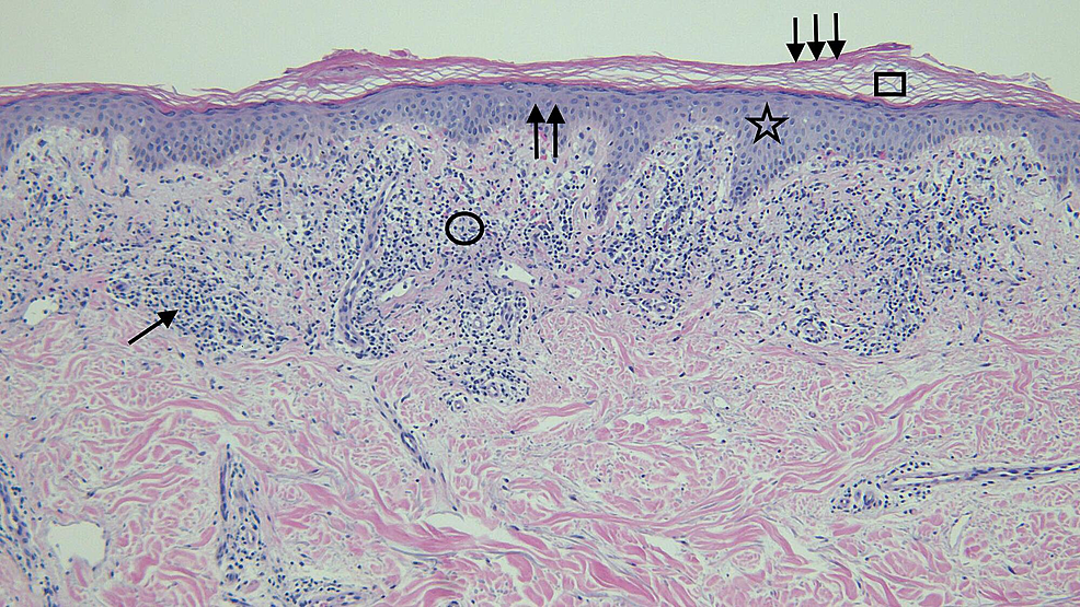 Testosterone Pellet Associated Dermatitis: Report and Review of ...