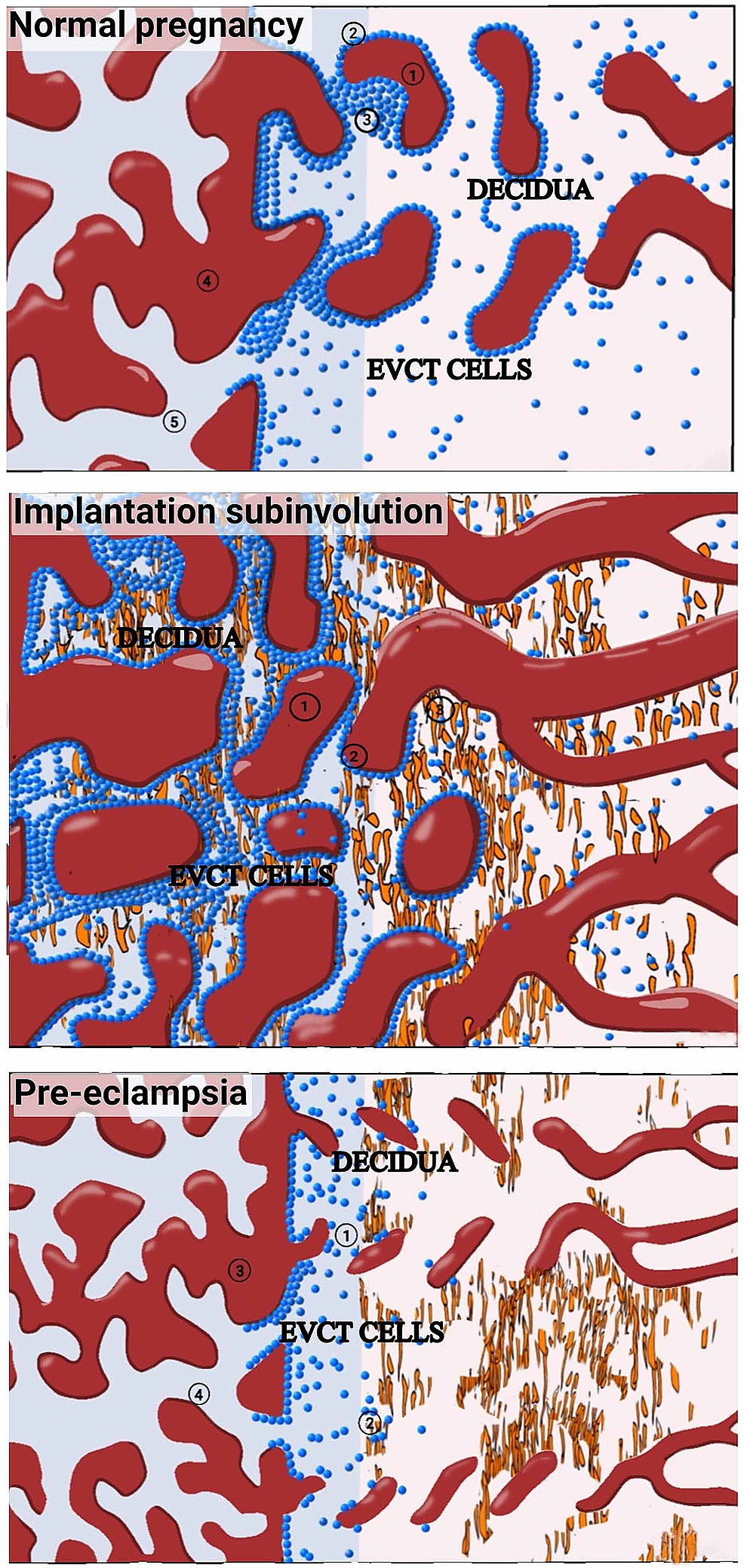 Pattern-of-trophoblastic-invasion-in-normal-pregnancy-(top);-pattern-of-trophoblastic-persistence-in-uterine-subinvolution-(middle);-and-preeclampsia-(bottom)
