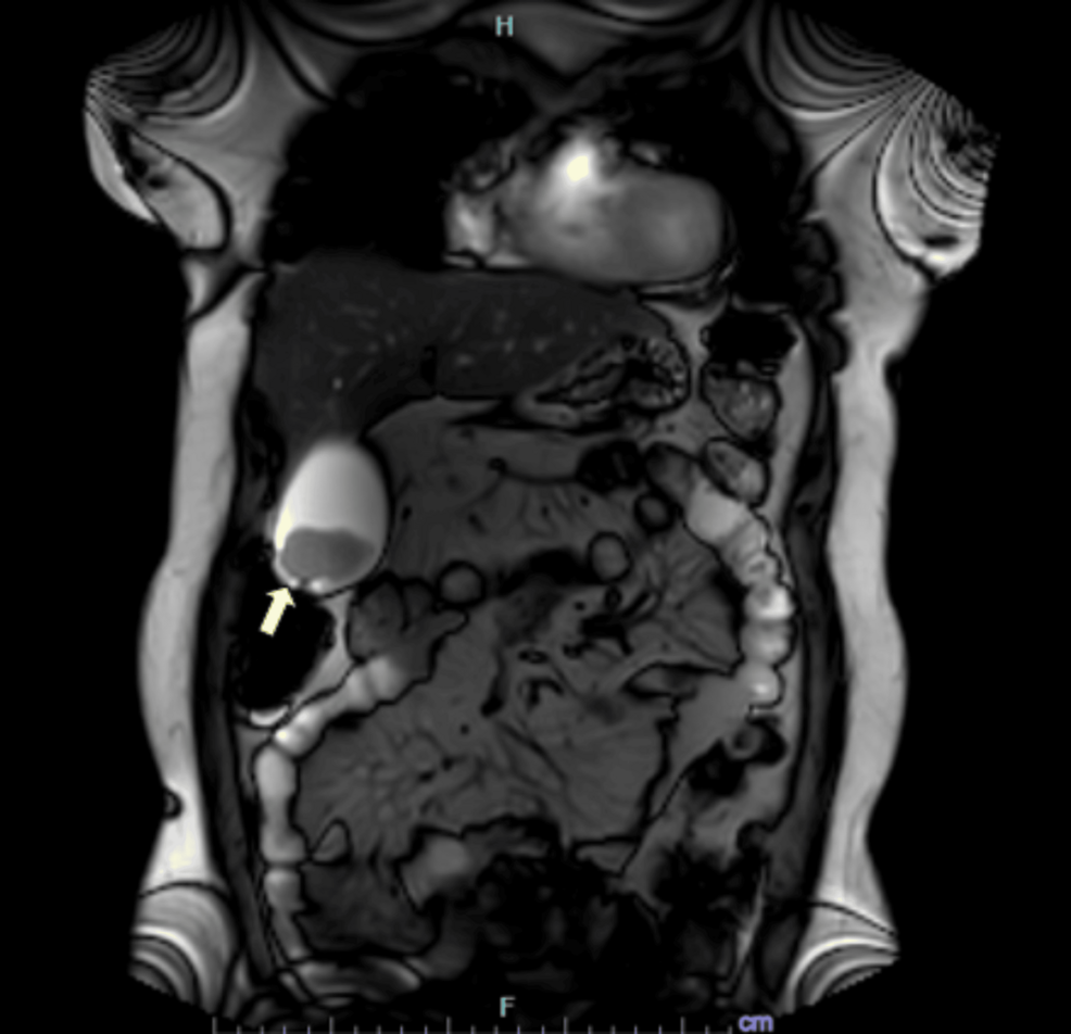 semaglutide gallbladder reddit 10 units of is how many mg: complete conversion guide for every concentration 🥇 16 Side Effects of