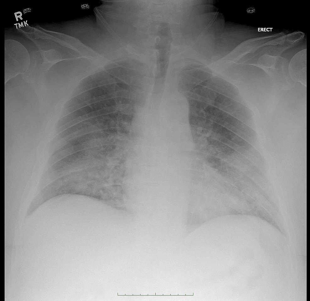 Cureus | Coagulopathy and Acute Respiratory Distress Syndrome: Dual ...