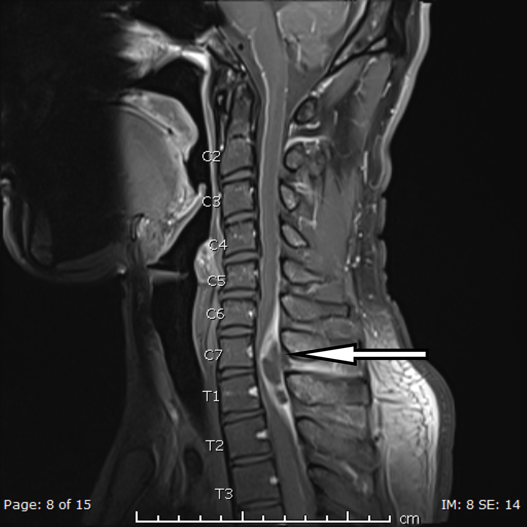 Cureus | A Case of Spinal Epidural Abscess Presenting with Horner Syndrome