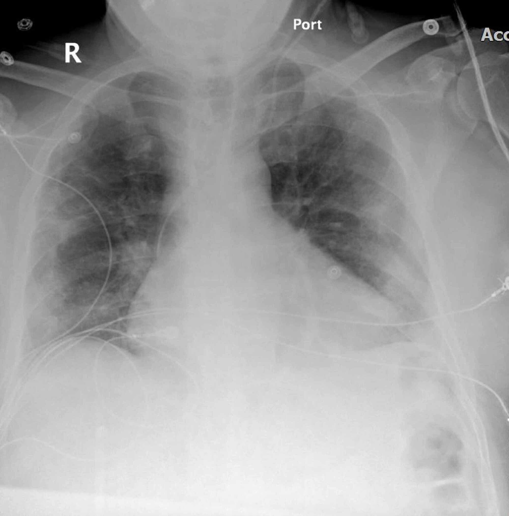 Cureus | Acute Coronary Syndrome and COVID-19: A Case Report of ...