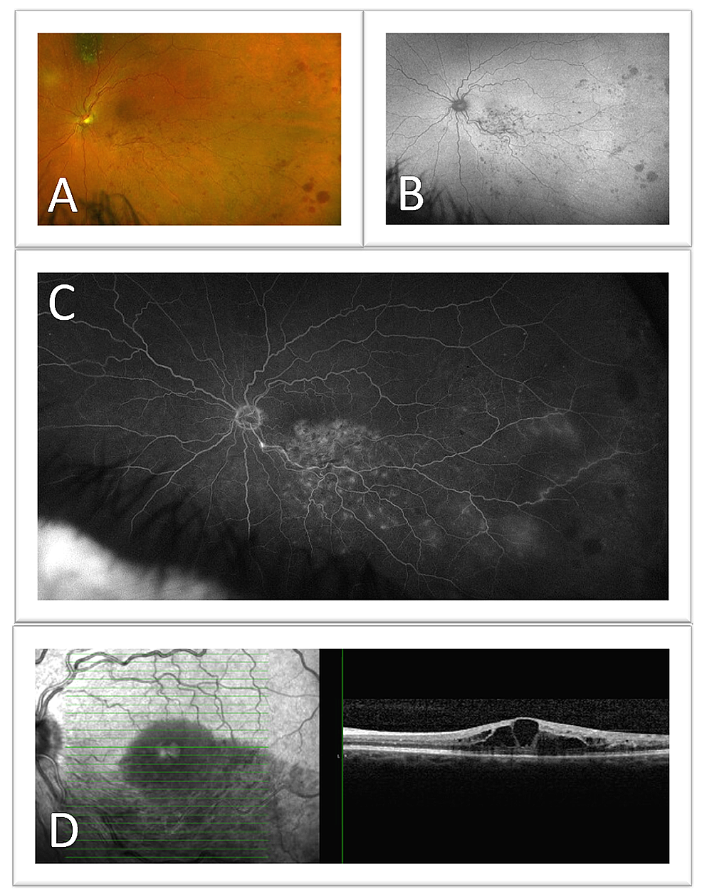 Cystoid-macular-edema-(CME)-in-the-setting-of-a-branch-retinal-vein-occlusion-(BRVO)-of-the-left-eye
