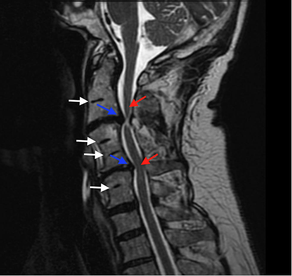 Wasp-waist sign (spine), Radiology Reference Article