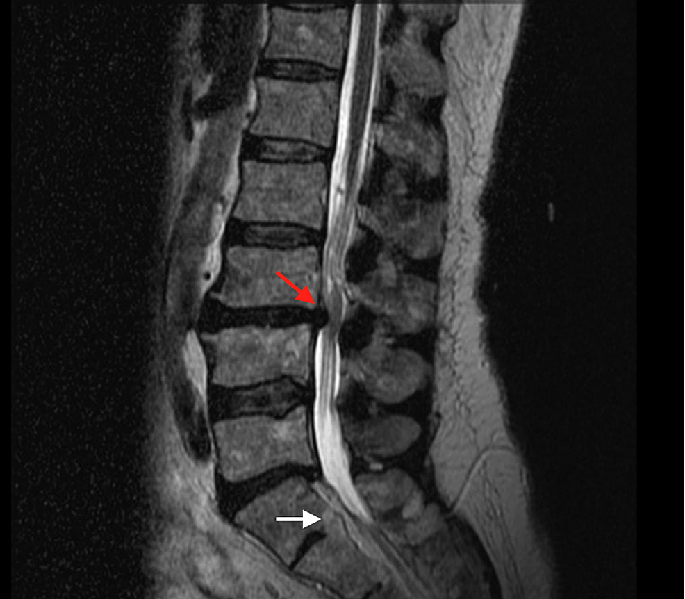 Cureus Images in Spine A Rare Abnormal Bony Fusion