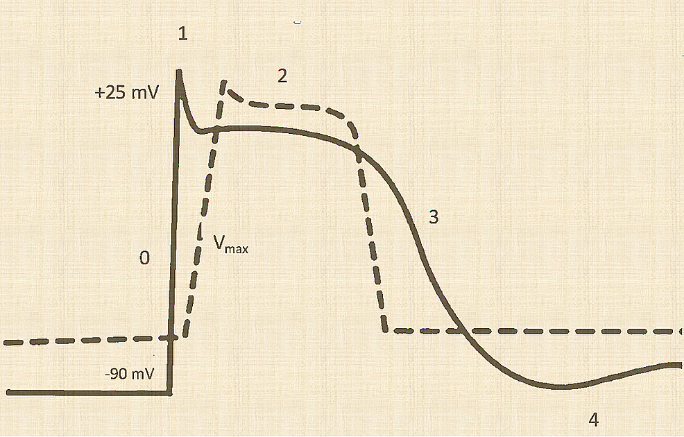 Cureus Cardiac Manifestations in a Case of Severe Hyperkalemia