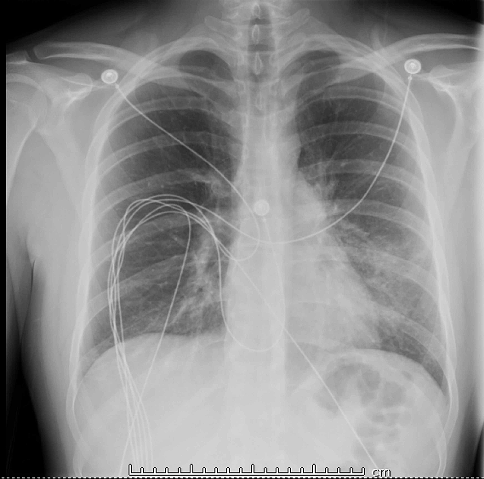 Cureus EVALI ECigarette or Vaping Product UseAssociated Lung