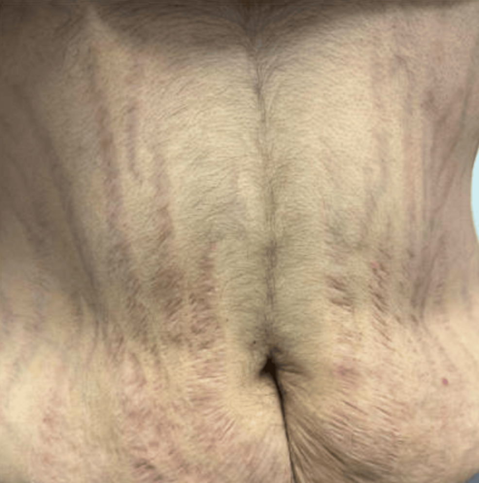 Purplish-(violaceous)-abdominal-striae-over-the-abdomen.